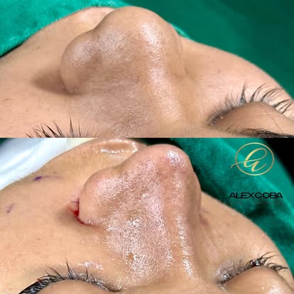 Rinoplastia Ultrasónica