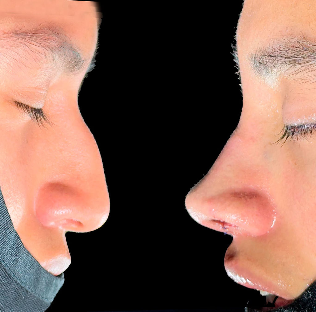 Rinoplastia Ultrasónica