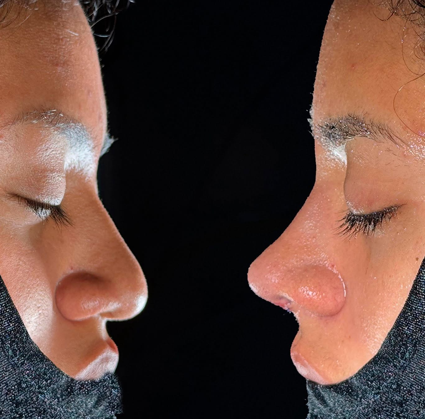 Rinoplastia Ultrasónica