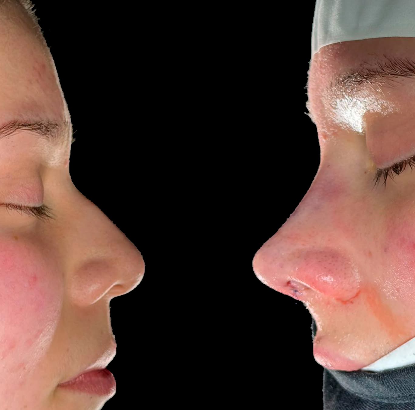 Rinoplastia Ultrasónica