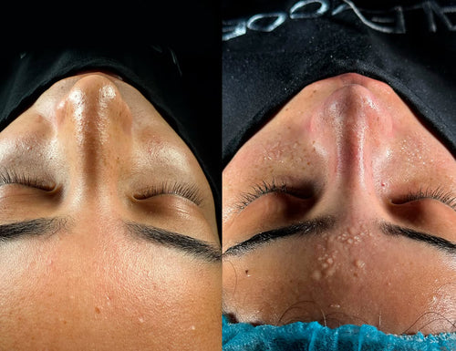 Rinoplastia Ultrasónica